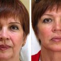 пластика лица от клиники АИДА 9
